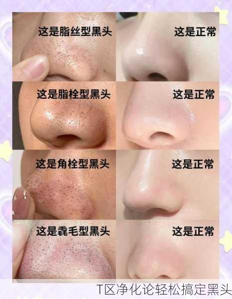T区净化论轻松搞定黑头