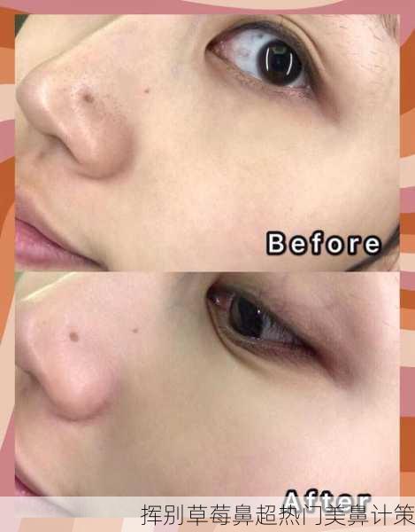挥别草莓鼻超热门美鼻计策