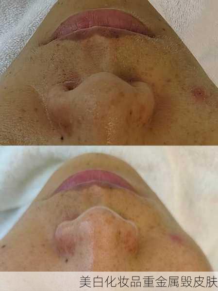 美白化妆品重金属毁皮肤