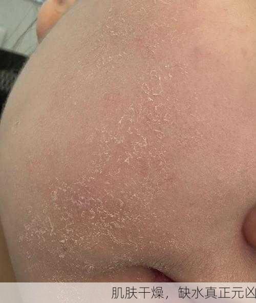 肌肤干燥,缺水真正元凶